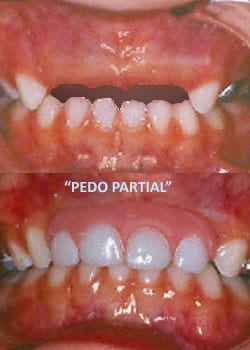 Pedo Partial San Diego | Cosmetic Dentistry of SD