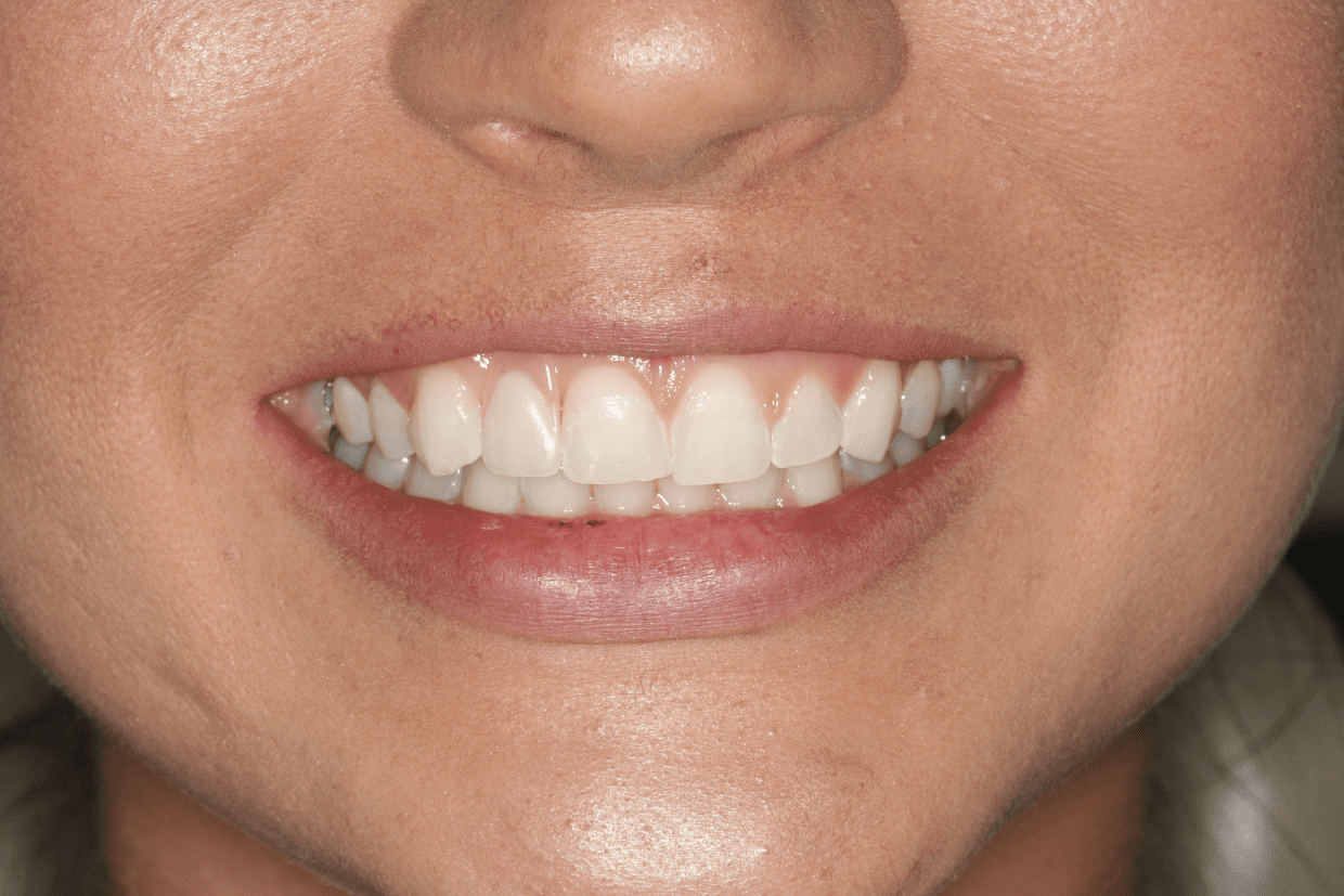 The Flipper A Temporary Tooth Cosmetic Dentistry